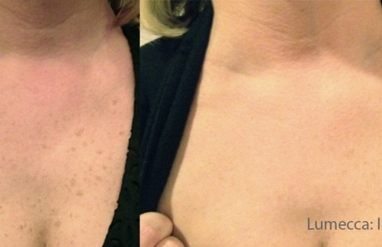 Behandlungsfortschirtt einer Beautybehandlung der Haut.