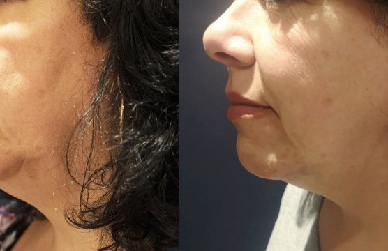 Behandlungsfortschritt einer Hautbehandlung.