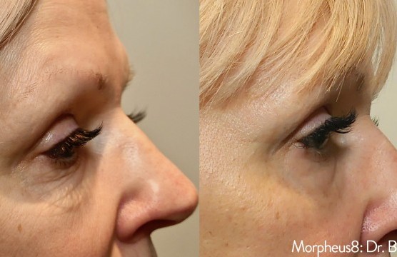 Behandlungsfortschritt einer Beautybehandlung.