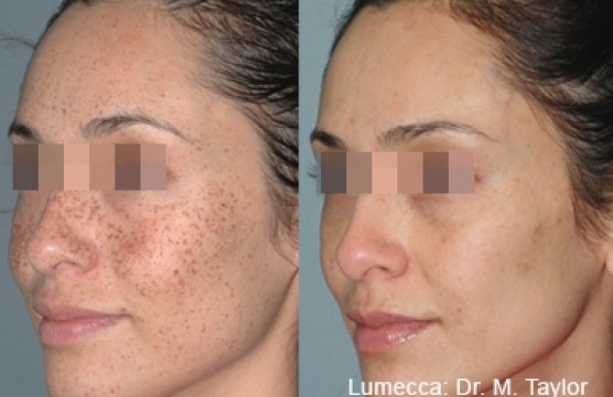 Vorher-Nachher-Vergleich einer Hautbehandlung.